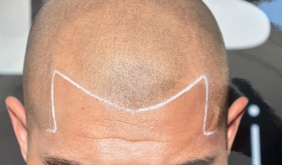 scalp micropigmentation before and after - scalp micropigmentation - hair tattoo - SMP