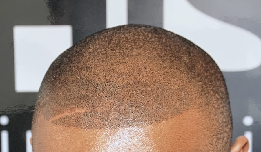 hair tattoo - scalp micropigmentation before and after