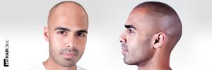 hair tattoo scalp micropigmentation before and after