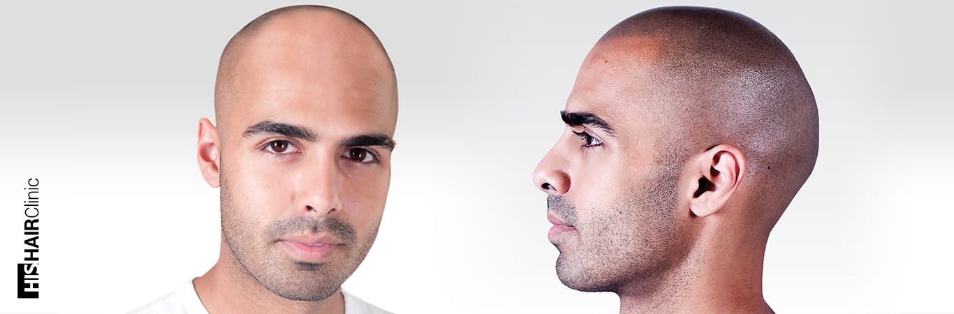 Scalp Micropigmentation Sarasota | Greco Dermatology