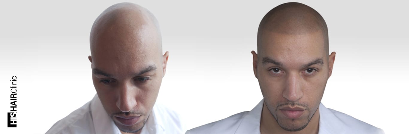 hair tattoo - scalp micropigmentation before and after