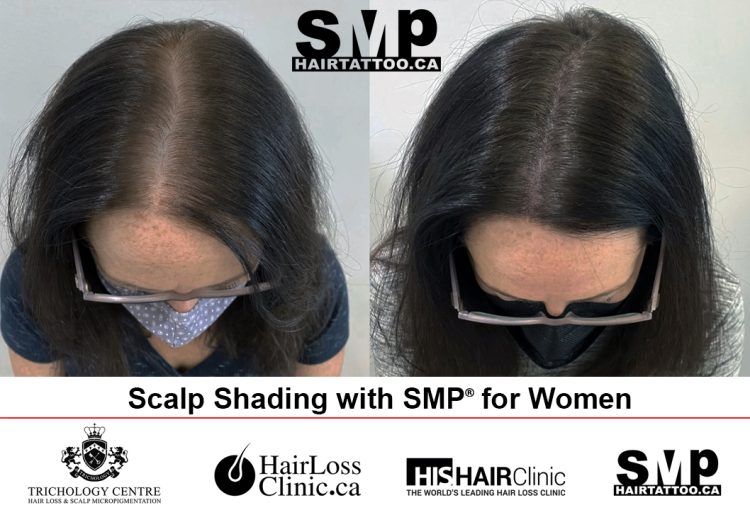 scalp micropigmentation women