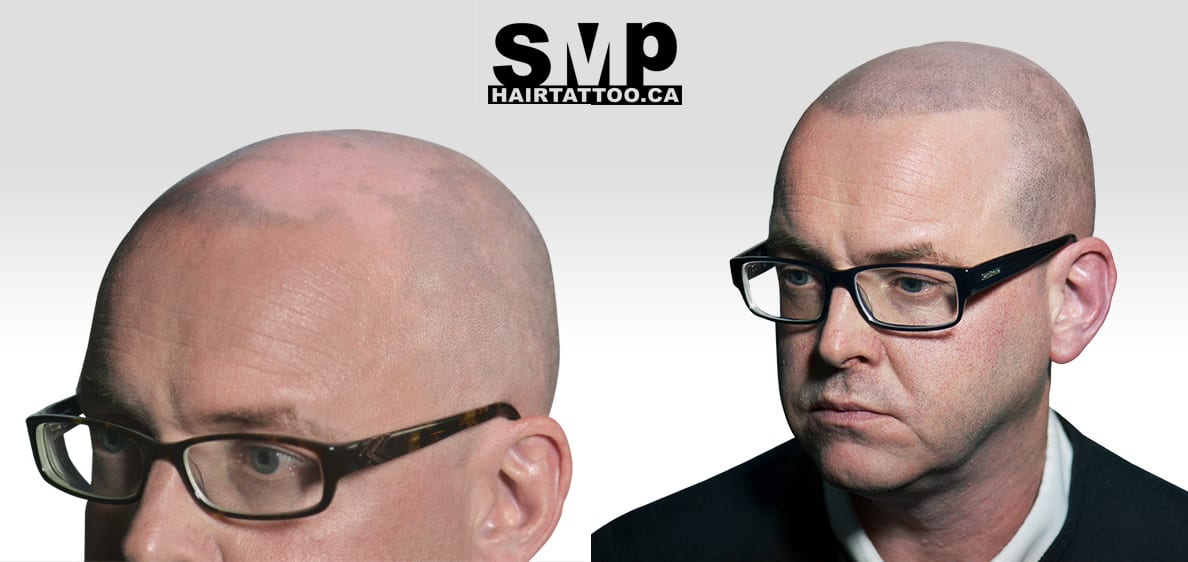 SMP for scarring alopecia