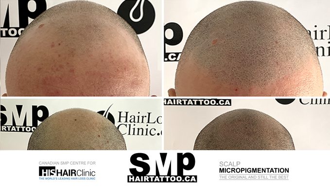 SMP hair micropigmentation Toronto ON