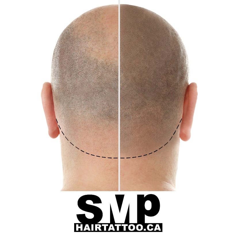 is smp scalp micropigmentation noticeable