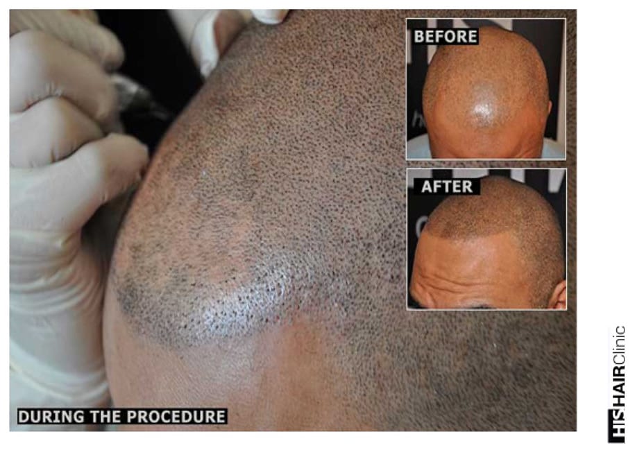 scalp micropigmentation for hair loss treatment