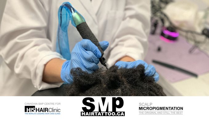 smp hair micropigmentation Toronto