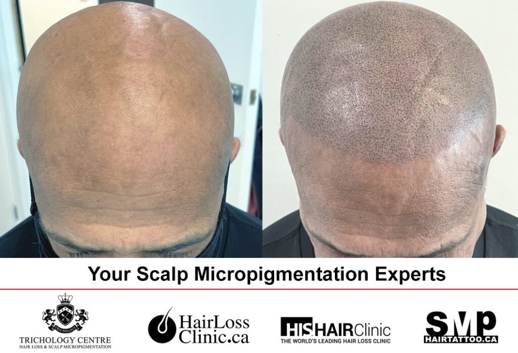 SCALP TREATMENT TORONTO | Free Online Hair Loss Assessment