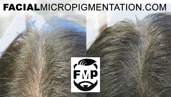 Micropigmentation for thinning hair