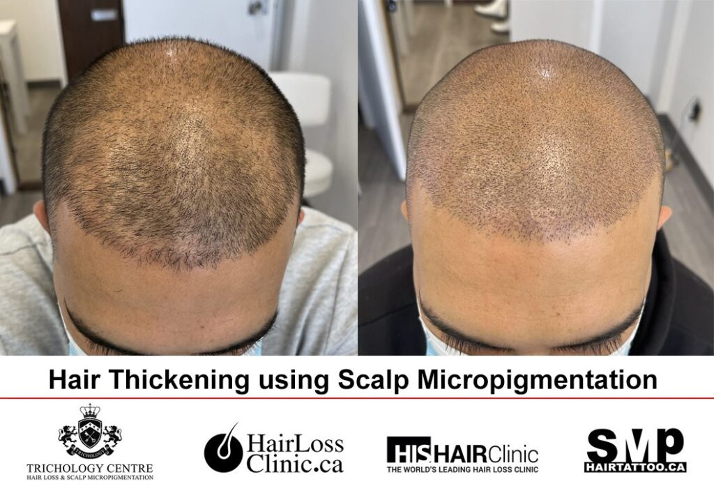 SMP for androgenetic alopecia Toronto