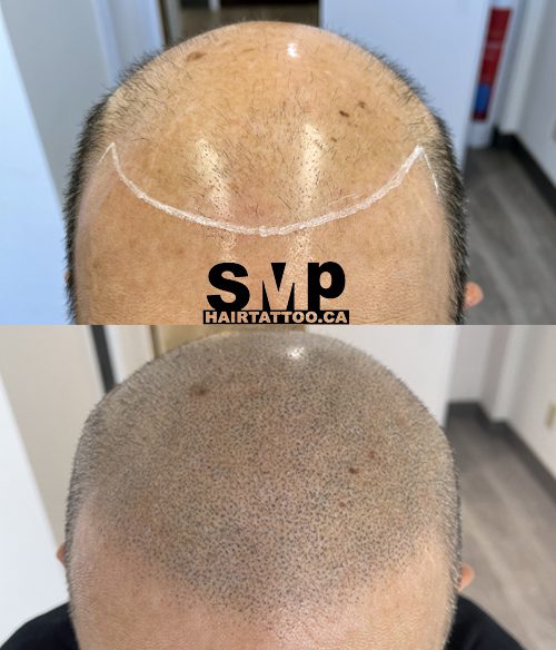 Does Scalp Micropigmentation Look Real Toronto