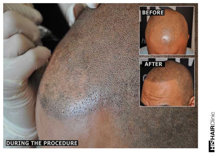 Is SMP effective treatment for Hair Loss