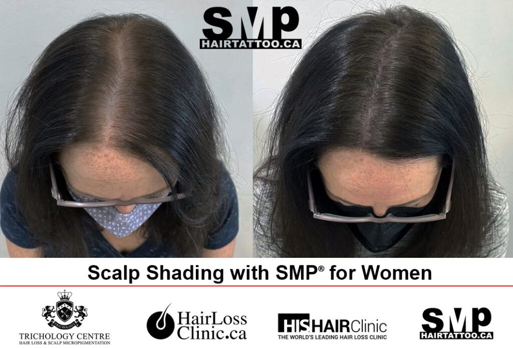 Scalp Micropigmentation Women