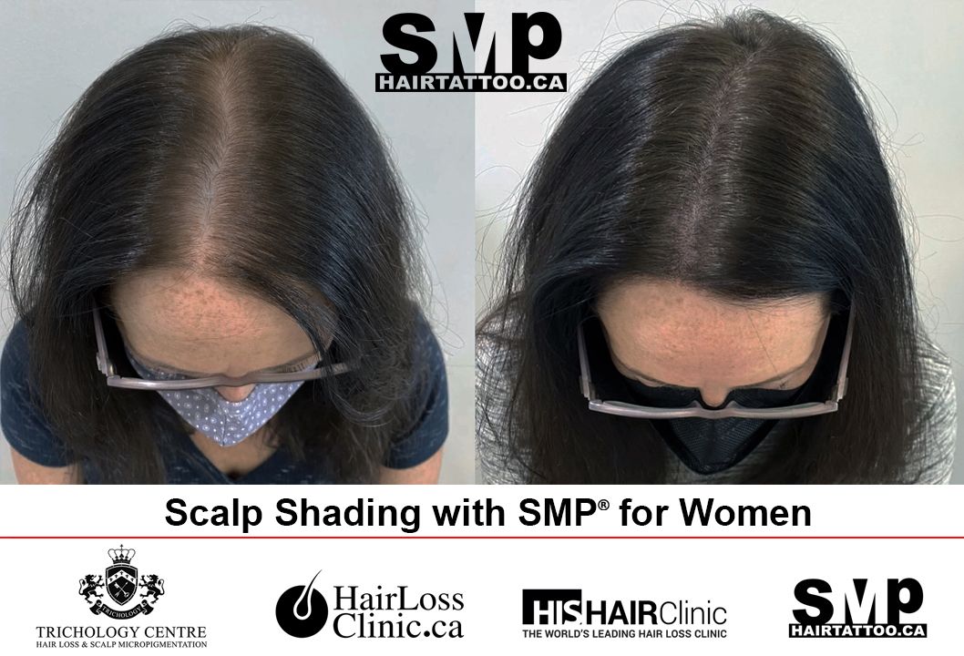 SMP Alopecia Treatment for Women