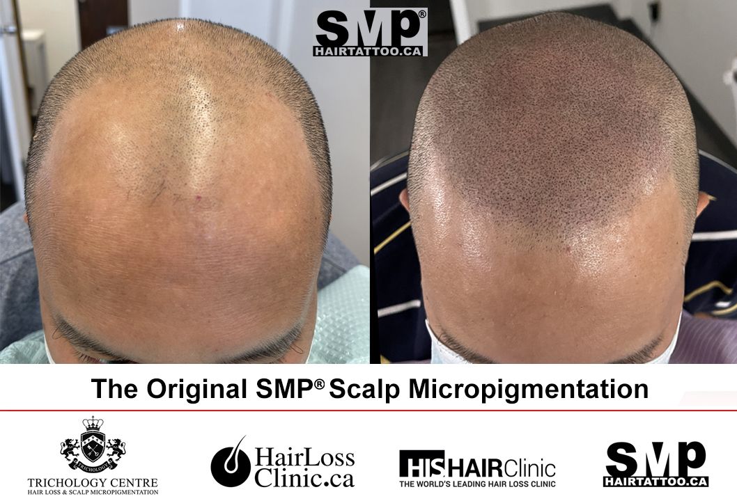 SMP treatment for hair loss
