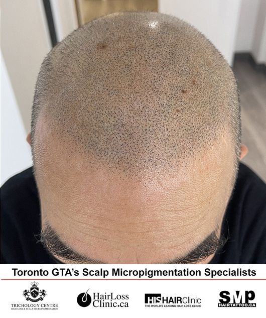 Scalp Micropigmentation Birmingham - Hair Tattoos - SMP