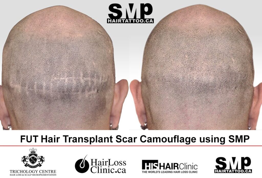 Micropigmentation Scalp for Hair Transplant Scars Toronto