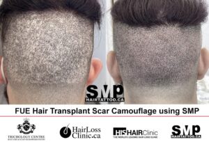Micropigmentation Scalp for Hair Transplant Scars Toronto