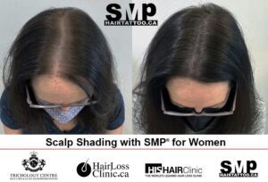scalp micropigmentation for women Toronto