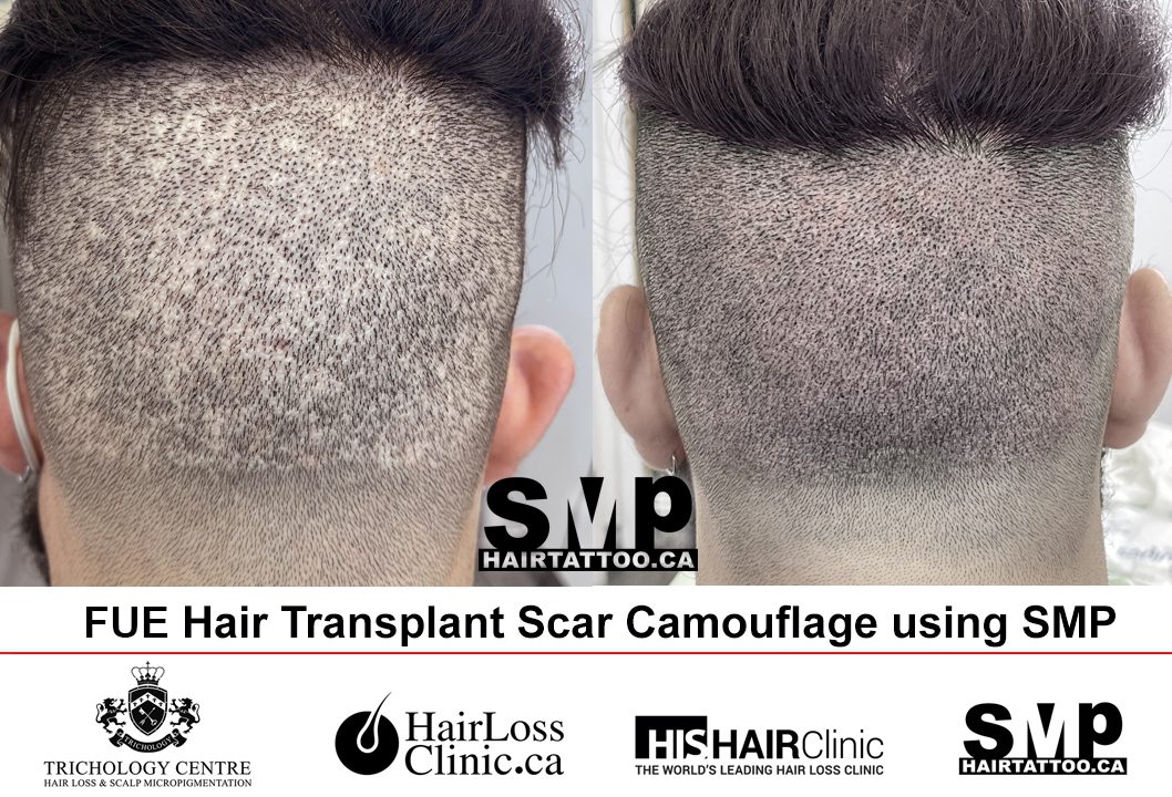 Scalp Micropigmentation Toronto: SMP Hair Tattoo Clinic