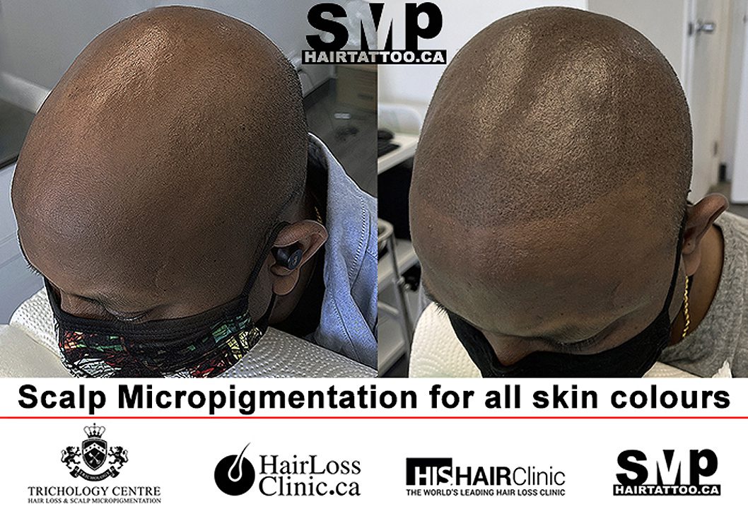 Scalp Micropigmentation for All Skin Colours