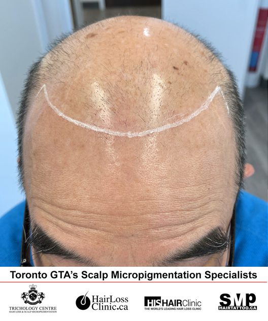hair tattoo before and after 1 Toronto