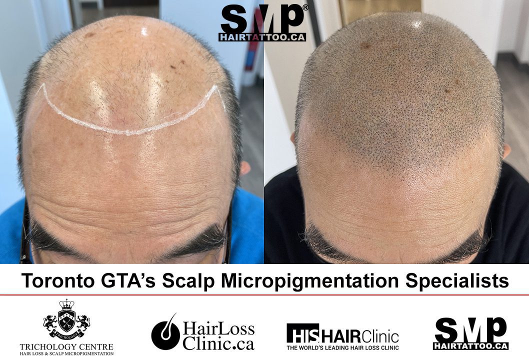 Scalp Micropigmentation Toronto: SMP Hair Tattoo Clinic