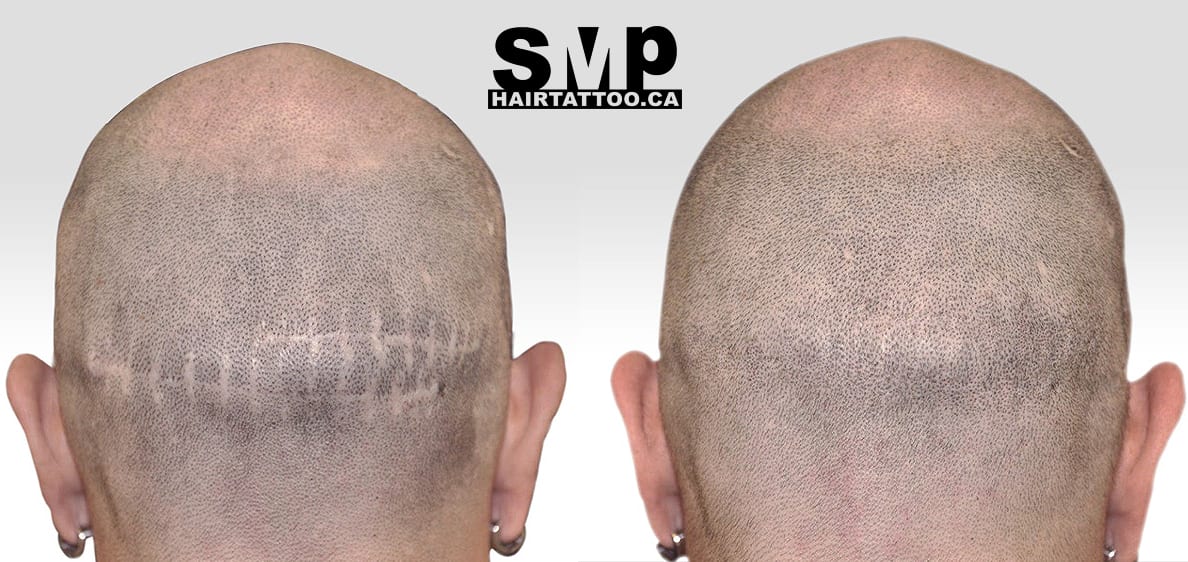 hair tattoo before and after Toronto