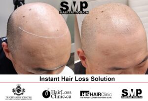 instant hair loss solution