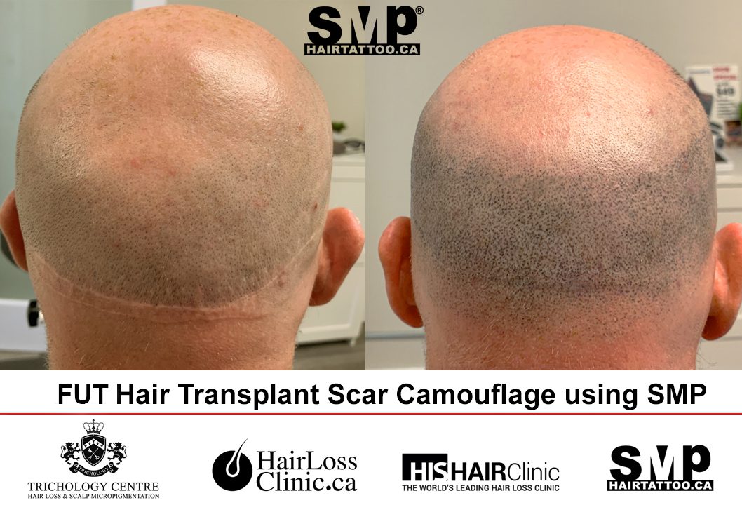 micropigmentation scalp Toronto