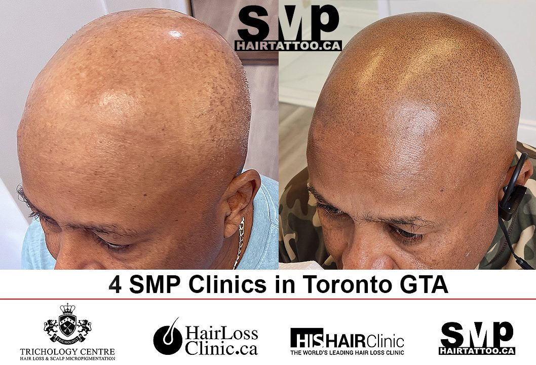 INSIDE LOOK Crazy Scalp Micropigmentation Result  YouTube