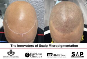 scalp micropigmentation before and after Toronto
