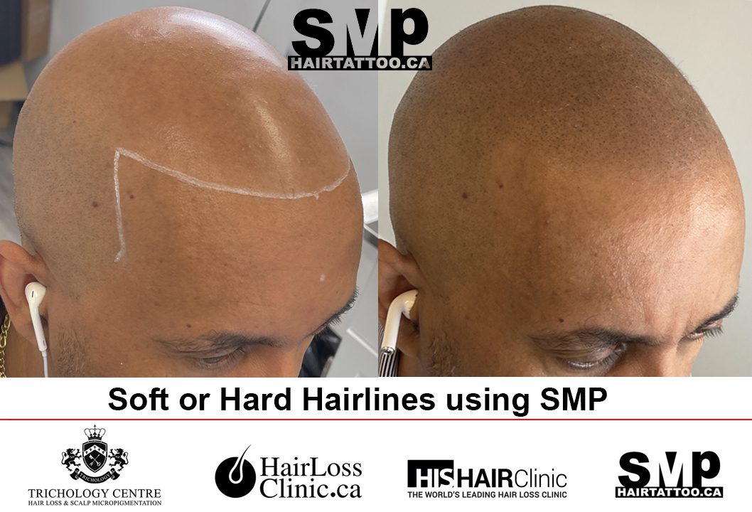 scalp micropigmentation