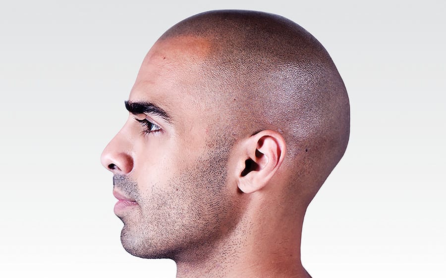 scalp micropigmentation