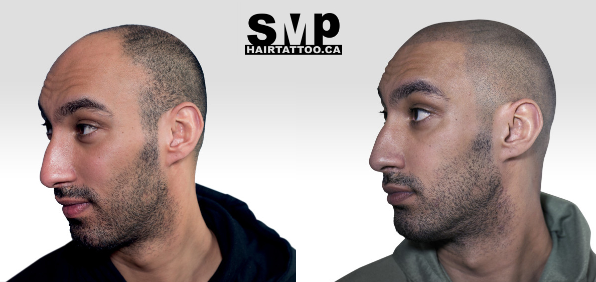 micropigmentation - scalp micropigmentation near me