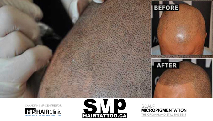 scalp micropigmentation vs hair transplant