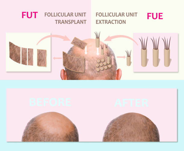 FUE and FUT hair transplant