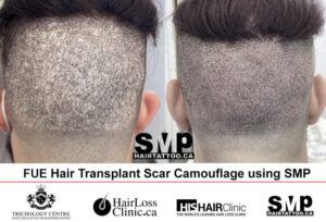 Micropigmentation-Scalp-for-Hair-Transplant-Scars