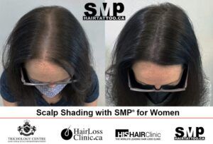 SMP-Alopecia-Treatment-for-Women