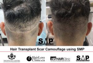 Scalp-Micropigmentation-Before-and-After