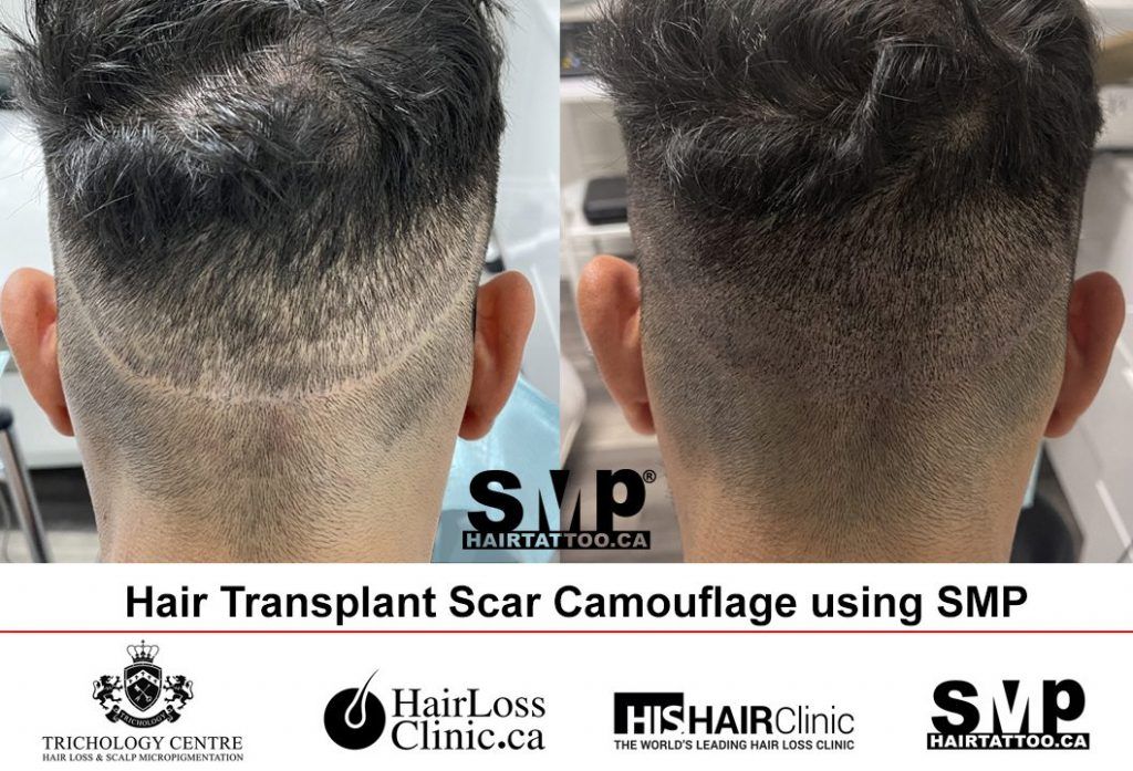 Scalp-Micropigmentation-Before-and-After