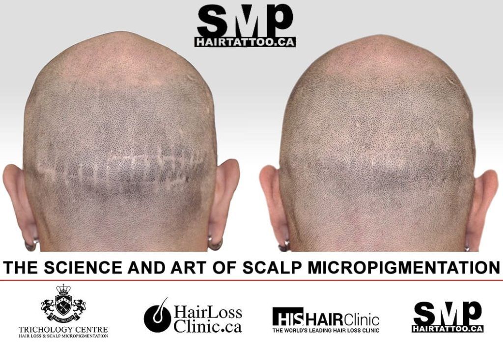before-and-after-scalp-micropigmentation-Toronto