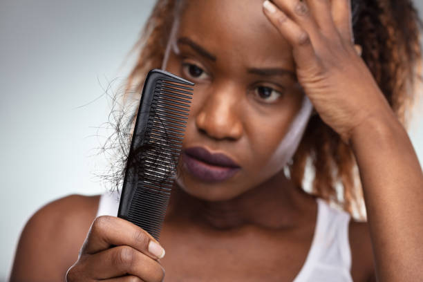 female pattern baldness - female patter hair loss