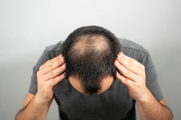 hair loss treatment