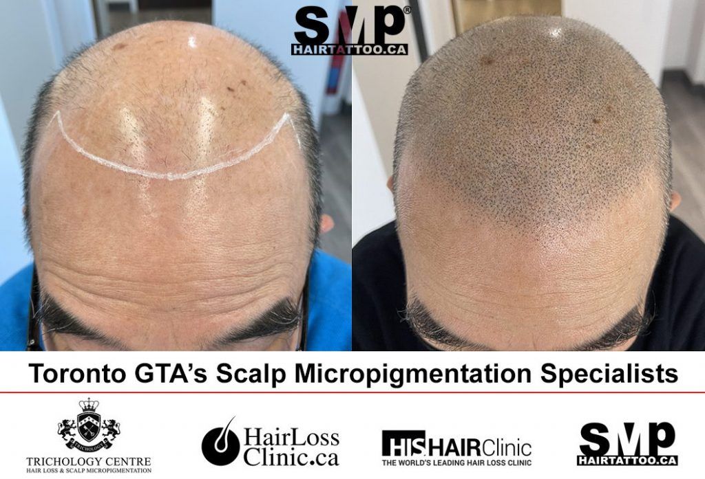 hair tattoo before and after SMP Toronto 1024x697 1jpg