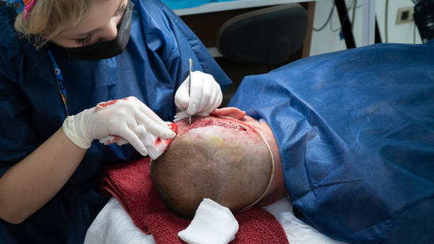 hair transplant in toronto