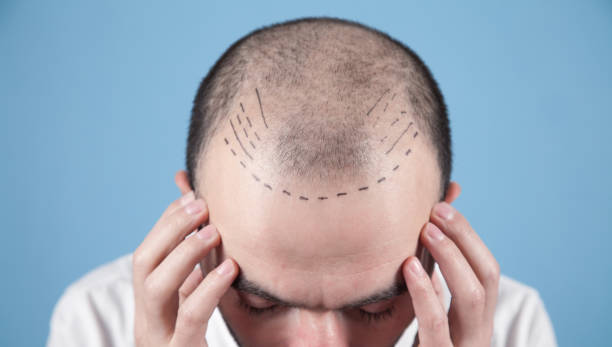 hairline tattoo - SMP - hair tattoo