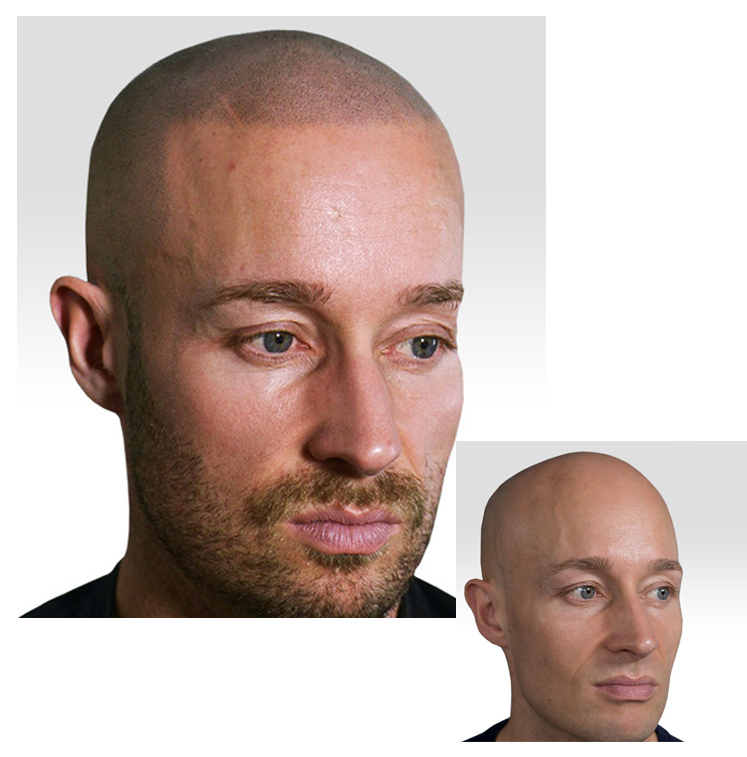 Navigating Scalp Micropigmentation Regrets: Expert Advice