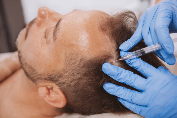 prp hair treatment