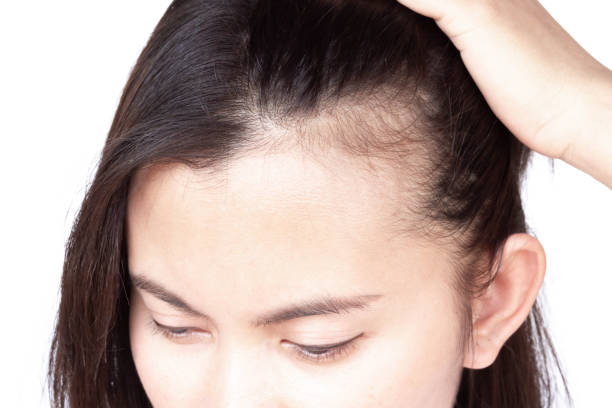 receding hairline - receding hairline women - hairline tattoo